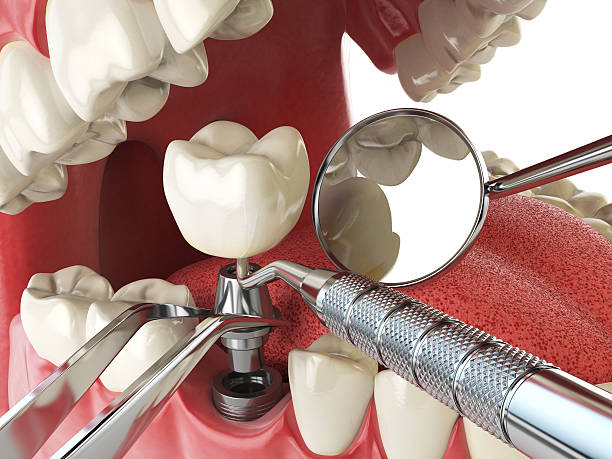 Best Knocked-Out Tooth (Avulsed Tooth) Treatment in Alameda, CA